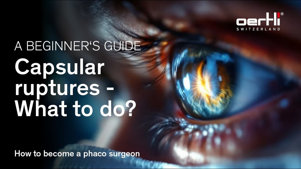 How to deal with capsular ruptures | Beginners guide | How to become a phaco surgeon | Cataract