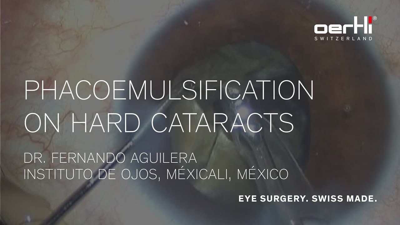 Surgery Video: Phacoemulsification on hard cataracts by Fernando Aguilera