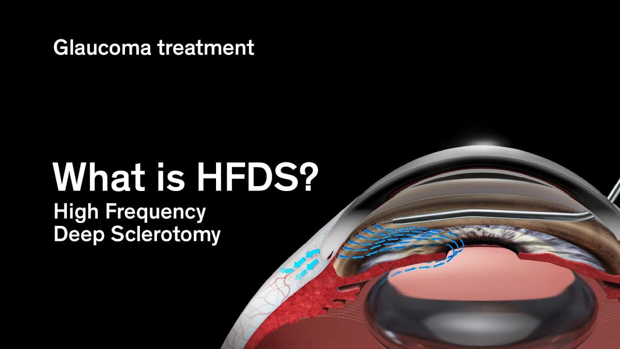 Spotlight: What is HFDS? | Glaucoma treatment