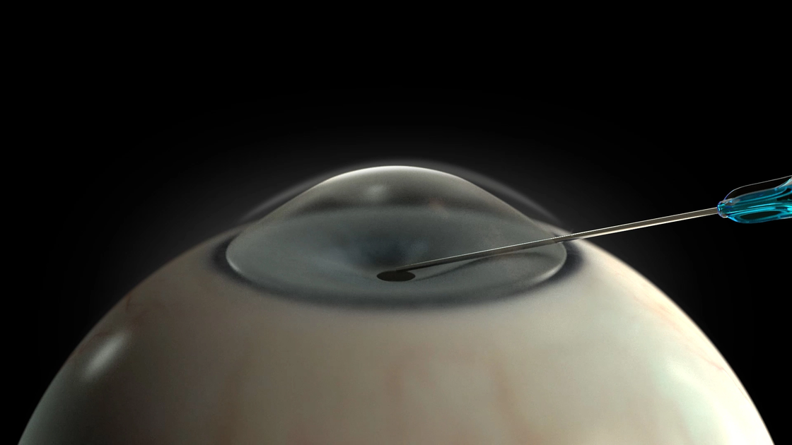 Graphic Position the anterior chamber
