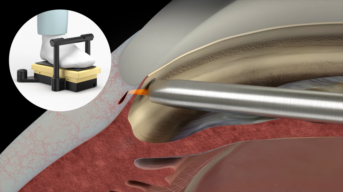 Graphic HFDS procedure