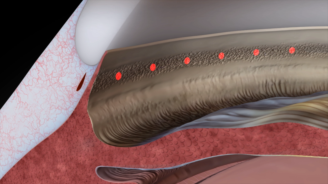 Graphic Positioning in the iridocorneal angle