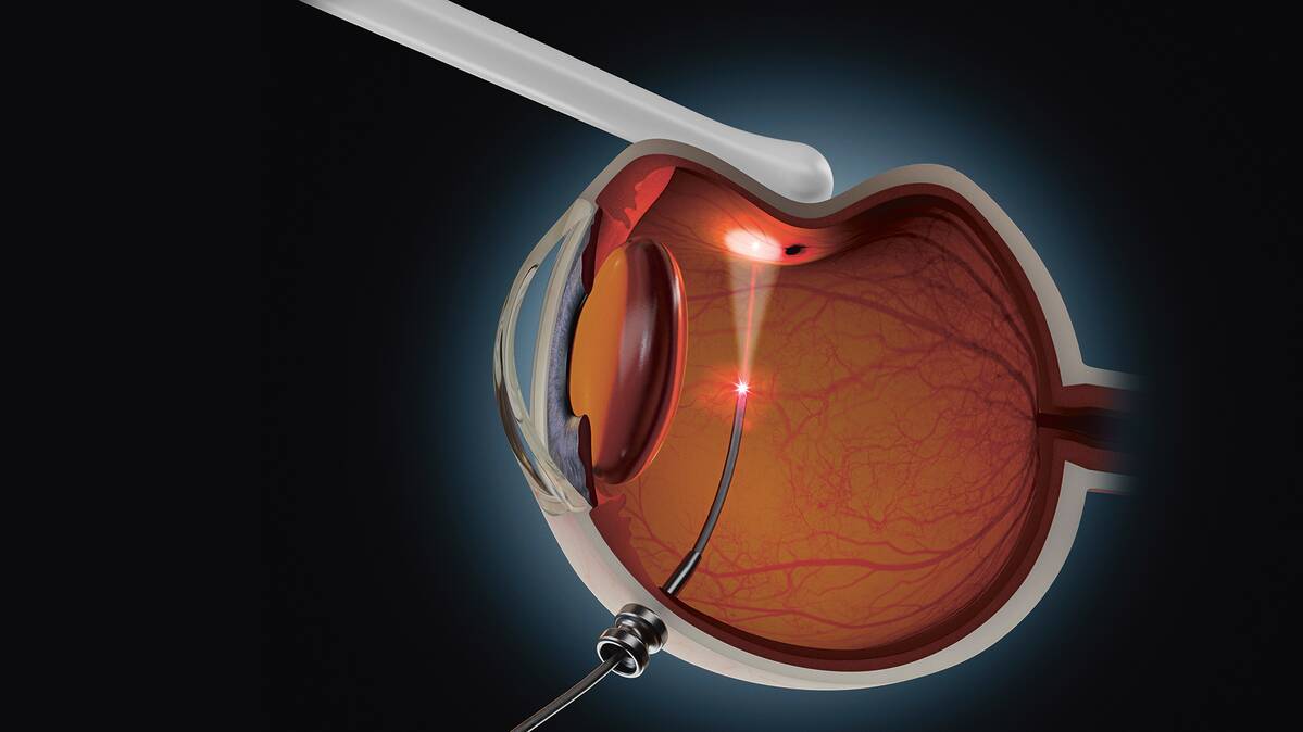 Endolaser Oertli Instrumente AG Making the difference in eye surgery